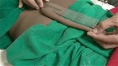 بالفيديو والصور.. مراهق هندي لديه ذيل طوله 20 سم