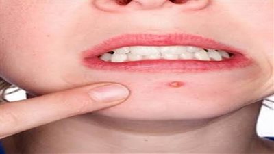 علاج الهربس الفموي