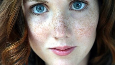 6 طرق تساعدك على التخلص من النمش والكلف