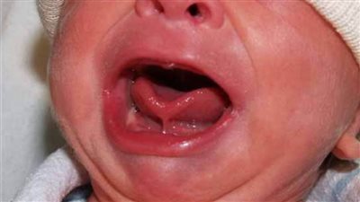 أفضل توقيت لإجراء عملية اللسان المربوط للأطفال