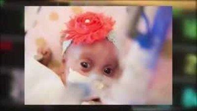 بالفيديو.. ولادة أصغر طفلة في العالم بحجم «أيفون»