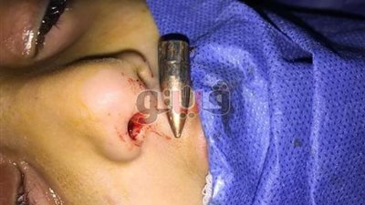 بالصور.. تسليم الرصاصة المستخرجة من رأس طفل ههيا لنيابة الشرقية