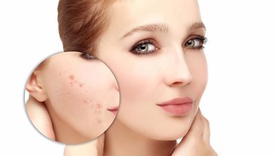 ماسك جوز الهند للتخلص من حبوب البشرة