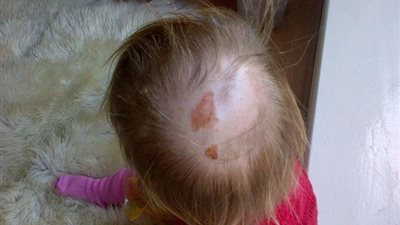 بالصور.. الألعاب النارية تصيب طفلة بحروق في الرأس