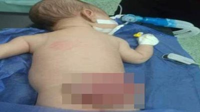 اسئصال ورم بالظهر لطفل حديث الولادة ببنها التخصصي