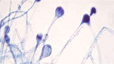 استشاري فيروسات: الإفراط في تناول الزنك قد يزيد فرص الإصابة بالفطر الأسود