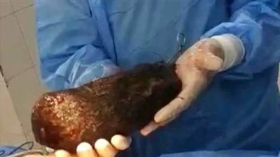 لحظة استخراج لُفافة شعر تزن 3 كيلو من معدة شاب في مطروح | فيديو