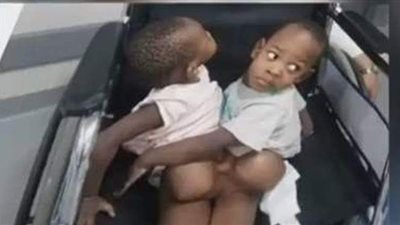 تفاصيل فصل توأم ملتصق من بوروندي بمستشفى الدمرداش | فيديو