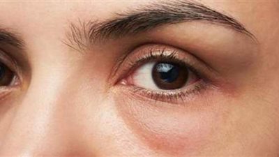 طرق التخلص من الانتفاخ أسفل العين