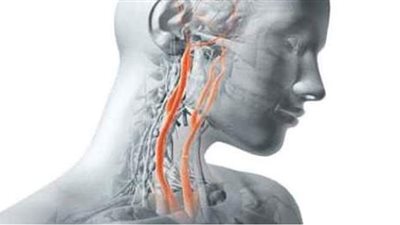«أستاذ أوعية دموية» يوضح كيف تحدث أمراض الشريان السباتي