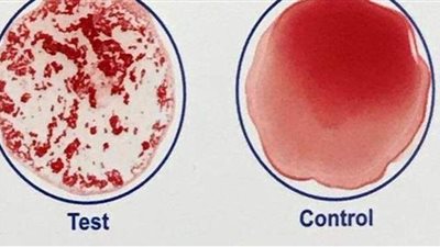 في بضع دقائق.. اختبار دم يكشف الملقحين ضد كورونا