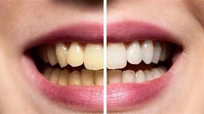 ٦ وصفات طبيعية للحصول علي أسنان ناصعة البياض