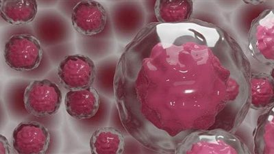 مفاجأة سارة.. تقنية جديدة توقف انتشار الورم السرطاني