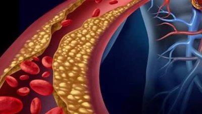 أفضل علاج للكوليسترول والدهون الثلاثية