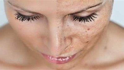 3 وصفات طبيعية لعلاج الكلف بشكل نهائي