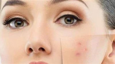 وصفات طبيعية للتخلص من حبوب الوجه
