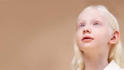 في اليوم العالمي للمهق.. أسباب وأعراض المرض وطرق الوقاية منه