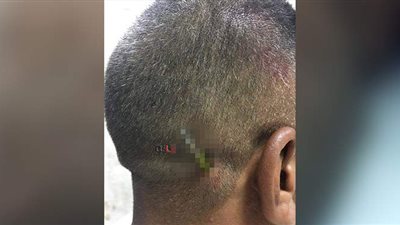 مستشفى سوهاج الجامعي ينجح في استخراج مفك طوله ١٠ سم من رأس مواطن | صور