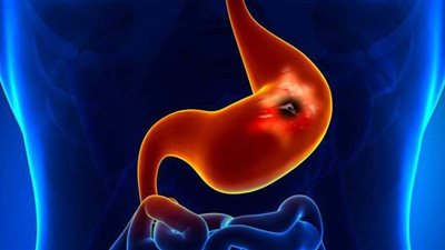أعراض قرحة المعدة وطرق علاجها بالأطعمة