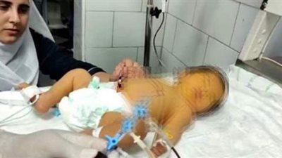 تغيير دم كامل لطفل مبتسر في الساعات الأولى من عمره بمستشفى شربين المركزي