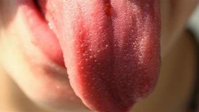 6 نصائح للوقاية من فطريات الفم