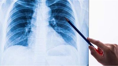 يصيب المتعافين من كورونا.. عدوى الفطر الأخضر وباء جديد يضرب الهند