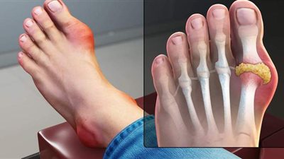 أعراض مرض النقرس وطرق العلاج