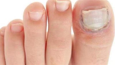 تعرف على أهم الطرق الطبيعية لعلاج فطريات الأظافر