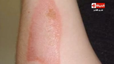 بالفيديو.. أنواع الحروق وطرق علاجها