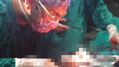 فريق طبي ينقذ مريضا من طعنة في القلب بالإسكندرية