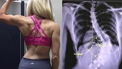امرأة تعيش بعمود فقري ملتوي ترفض تصحيحه لسبب غريب (صور)