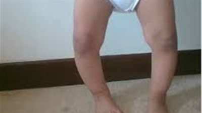 دراسة: تراجع فترات سطوع الشمس يزيد معدلات الإصابة بالكساح