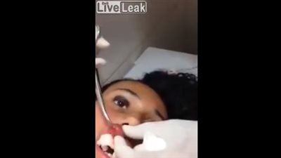 لقطات صادمة للحظة استخراج دودة عملاقة من شفاه فتاة (فيديو)