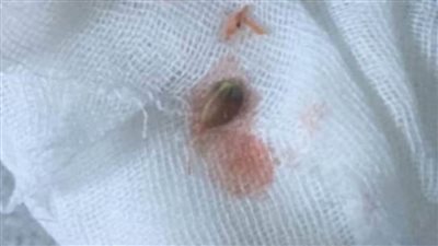 بذرة يوسفي هددت حياته.. فريق طبي ينقذ حياة طفل بالقليوبية