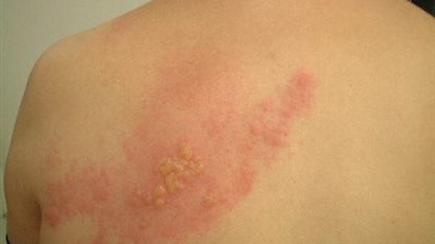 أعراض الإصابة بـ«الحزام الناري» وطرق العلاج والوقاية منه