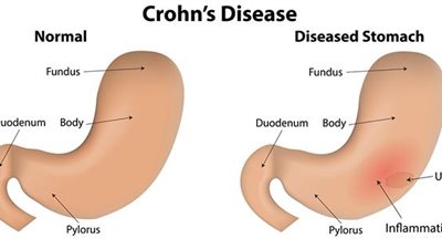 إنزيم بكتيري وراء الإصابة بمرض «متلازمة كرون»