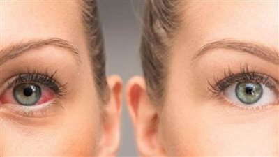 مرض المياه الزرقاء في العين | اختبار جديد للمساعدة في منع العمى المرتبط بـ