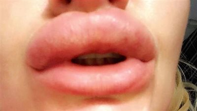 امرأة تقلد باربي تكتشف مادة لا تصدق في حشو شفاهها (صور)