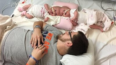 فصل نوع نادر من التوائم بنجاح في الولايات المتحدة (صور)