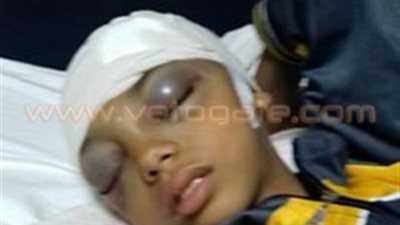 بالفيديو والصور.. إصابة طالب بشرخ في الجمجمة لسقوط عارضة عليه بالدقهلية