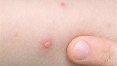 5 نصائح للوقاية من مرض 