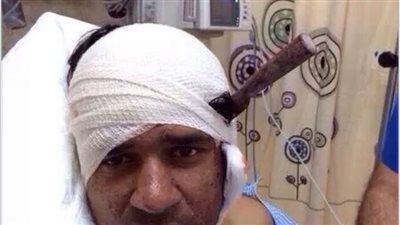 بالصور.. العناية الإلهية تنقذ شابا استقر سكين في رأسه بعمق 8 سم