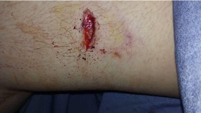 كلب يقتحم مدرسة ويعقر طالبتين بالشرقية.. والطب البيطري: لم نتلق بلاغات