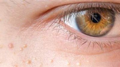 نصائح لعلاج الحبوب تحت الجلد