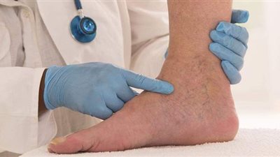 تعرف على علاج دوالي الساقين وأسباب الإصابة