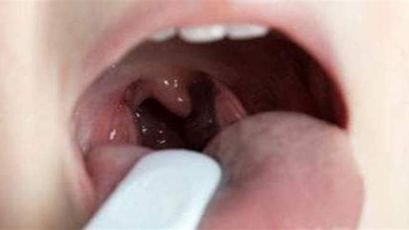 علاج التهاب الحلق