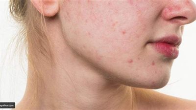 تناوليها يوميا وشوفي النتيجة.. 7 أعشاب طبيعية تخلصك من حب الشباب