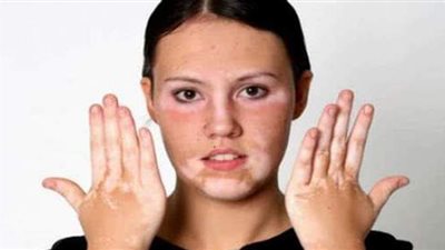 في اليوم العالمي للبهاق.. مليون مصاب به في مصر.. لا يوجد علاج له.. واستخدام مستحضرات التجميل لتغطية البقع