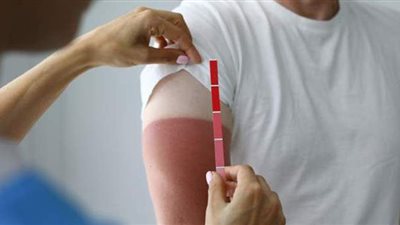 مشاكل الجلد في الصيف وطرق علاجها