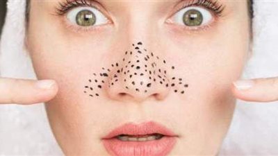 3 وصفات طبيعية لإزالة الرؤوس السوداء